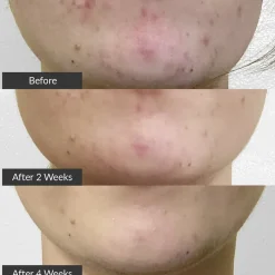 pmd. PMD Clean Clean Acne Elektrisches Gesichtsreinigungstool zur Behandlung von Akne von