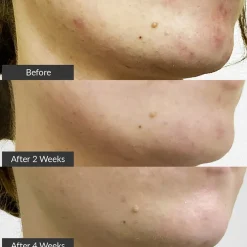 pmd. PMD Clean Clean Acne Elektrisches Gesichtsreinigungstool zur Behandlung von Akne von